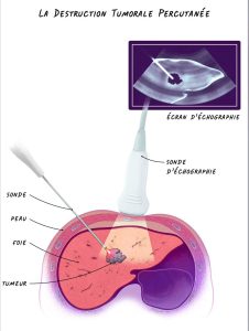 The Mohammed VI University Hospital in Agadir successfully performs its first radiofrequency treatment for liver cancer. WhatsApp Image 2026 06 13 at 12.06.58
