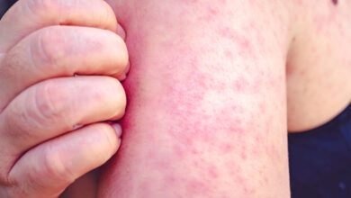 United Kingdom: Rapid Spread of Measles 4 rougeole hero